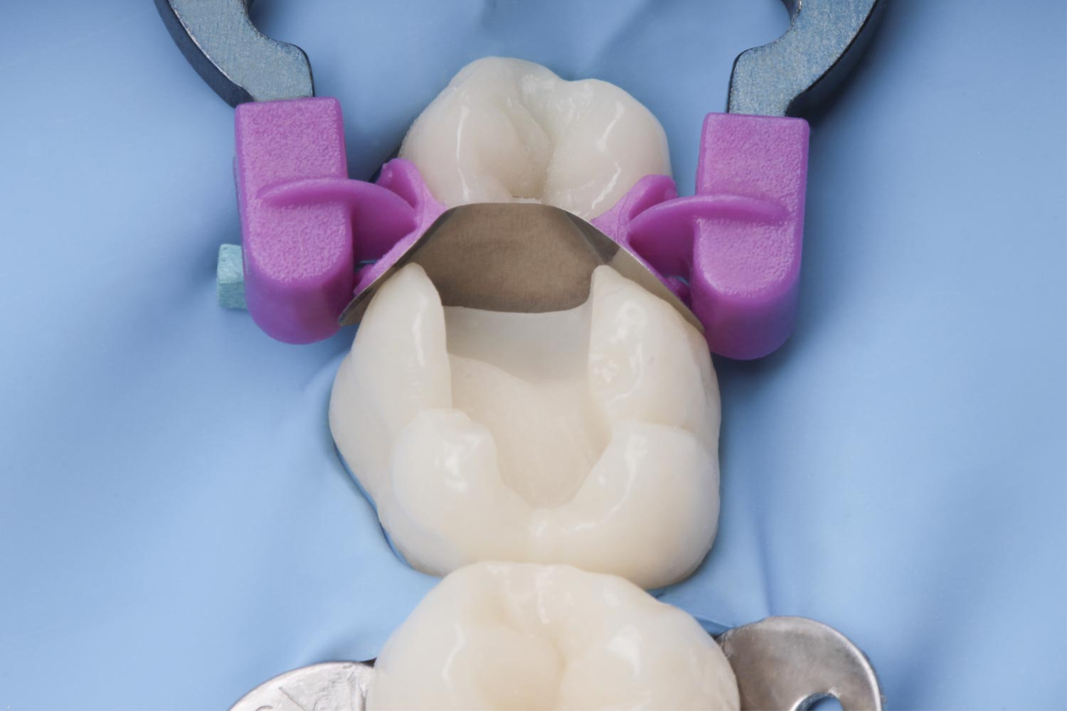 Polydentia_myQuickmat_Forte_starter_kit_ref_6883