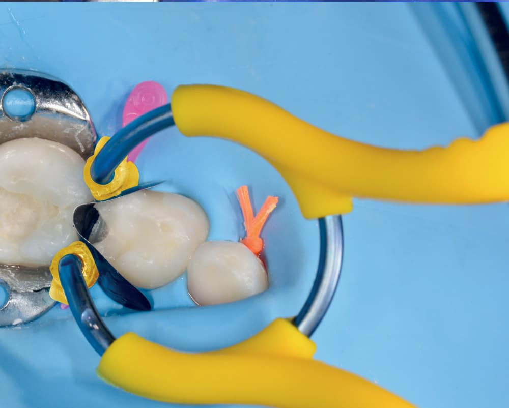 my-clip-junior-clinical-sectional-matrix-ring