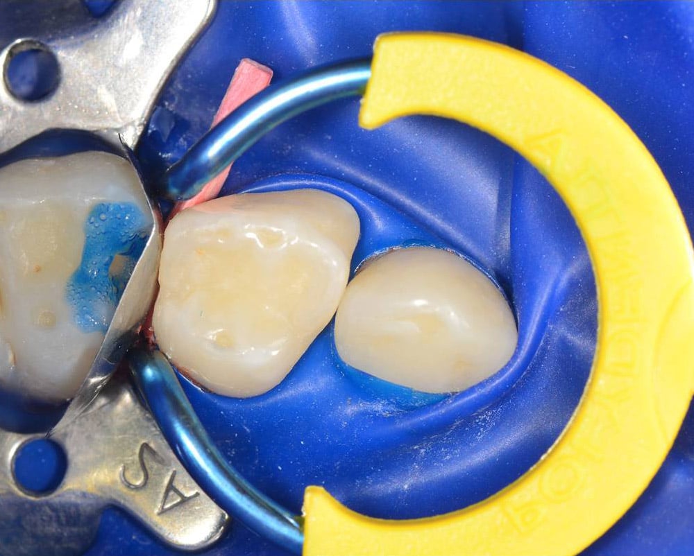 my-ring-junior-clinical-sectional-matrix-ring
