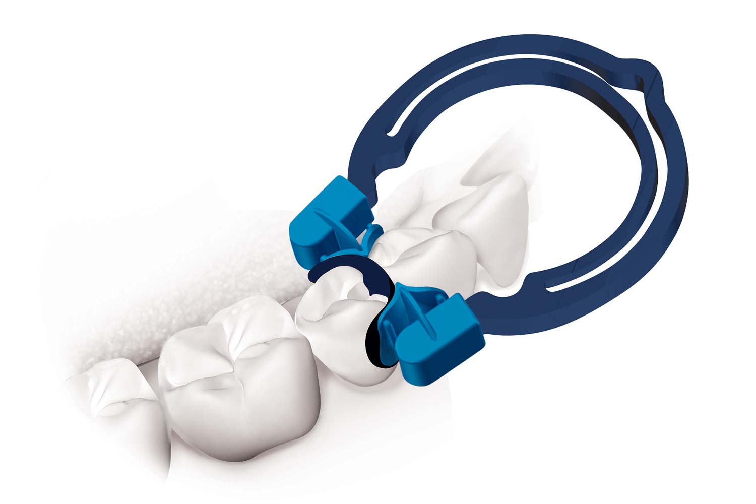 myQuickmat_ForteKit_02-1 (1)